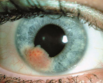 Melanoma de iris – Una lesión de melanoma ocular no pigmentado en el iris, con vasos sanguíneos visibles. Imagen cortesía de la colección de imágenes de la Academia Americana de Oftalmología.