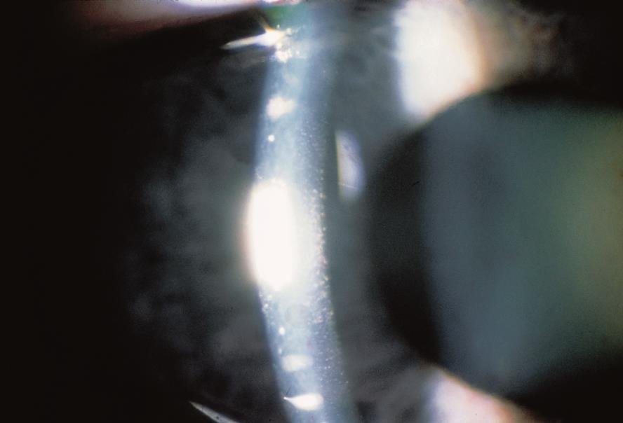 What Is A Corneal Ulcer American Academy Of Ophthalmology