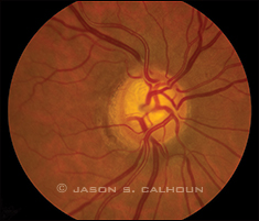 Early Manifest Glaucoma Trial