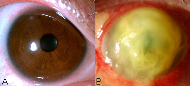 Figure 1. A small peripheral infiltrate (A) does not require culture,
but any corneal ulcer that is large or central (B) or presents
with suspicious features should be cultured.