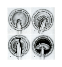 Four black and white illustrations of a medical tool entering a circular structure. The syringe-shaped tool appears to be sucking out the fluid on the inside of the circle, and each image shows more of the fluid disappearing.