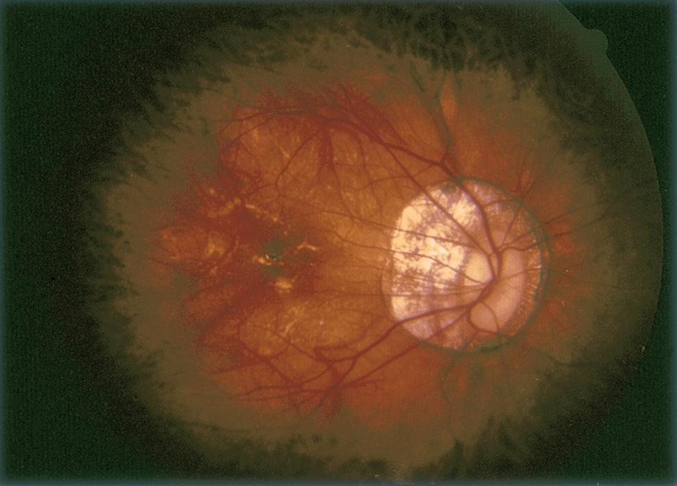 Pathologic myopia with tilted disc and peripapillary atrophy of RPE and