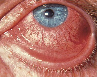 Inflammation from viral conjunctivitis