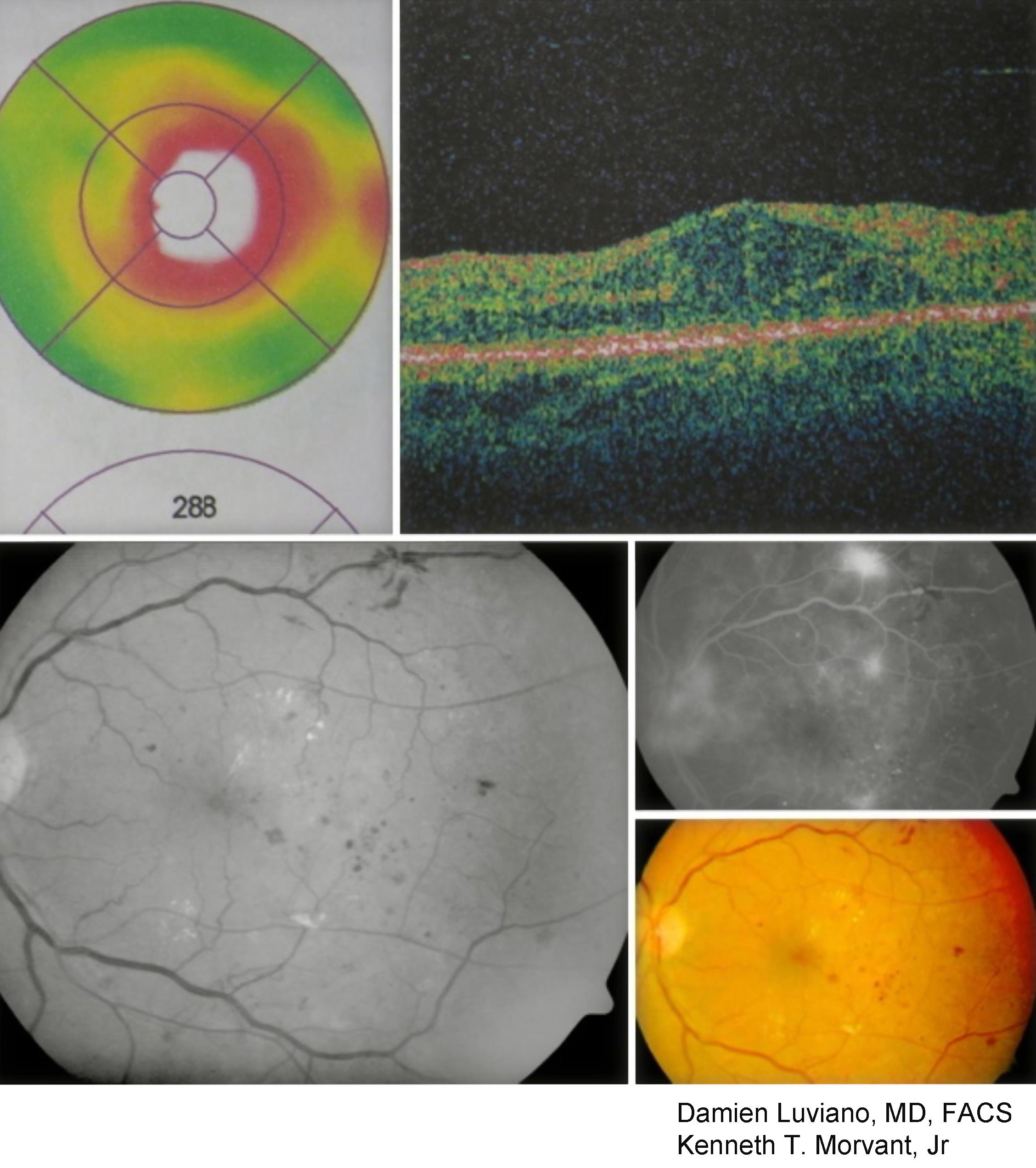 Diabetic retinopathy with macular edema - American Academy of Ophthalmology