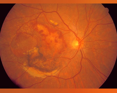 Photograph of the retina of a patient with Wet Macular Degeneration
