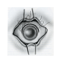 An black and white illustration of a human eye being held open by four metal wires. There are small black lines around the iris of the eye mimicking stitches or sutures.