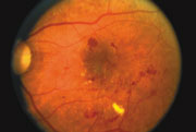 A retina showing signs of diabetic retinopathy