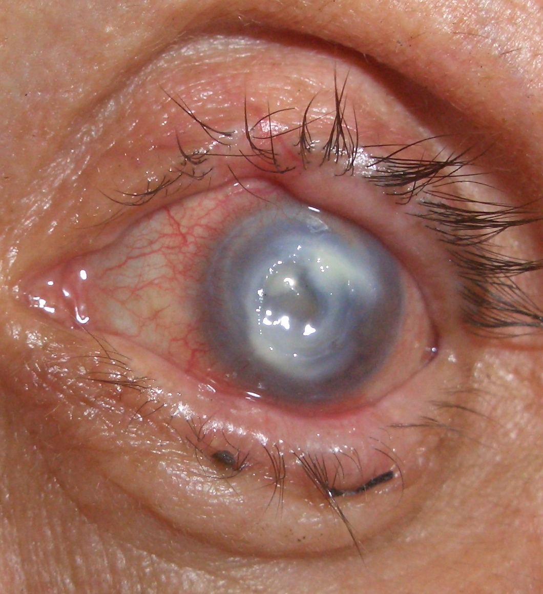 Infectious central corneal ulcer - American Academy of ...
