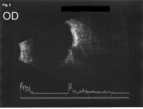 B-Scan Ultrasonography 2