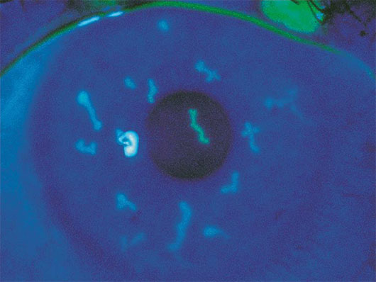 Fluorescein stain highlighting dendritiform lesions in herpetic keratitis