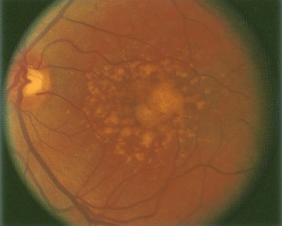 Photograph of the retina of a patient with Dry Macular Degeneration, showing soft confluent drusen.