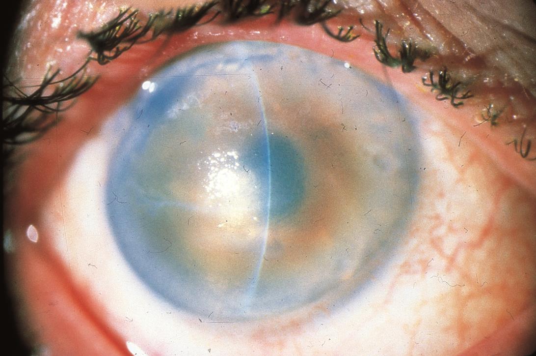 Pseudophakic bullous keratopathy - American Academy of Ophthalmology