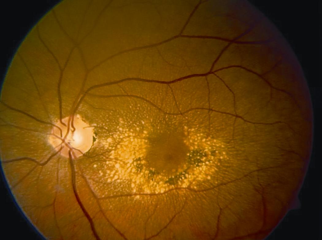 Doyne honeycomb retinal dystrophy - American Academy of Ophthalmology
