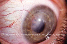 Corneal Allograft Rejection Adjacent to Neovascularization