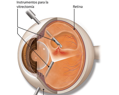 Ilustración de la cirugía de vitrectomía. La vitrectomía es un tipo de cirugía ocular que se usa para tratar los problemas de la retina y el vítreo del ojo.