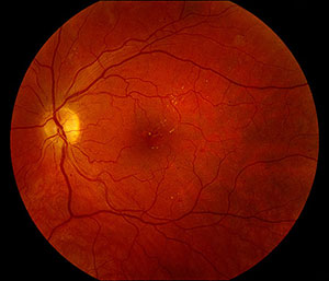How to Classify the Diabetic Eye - American Academy of Ophthalmology