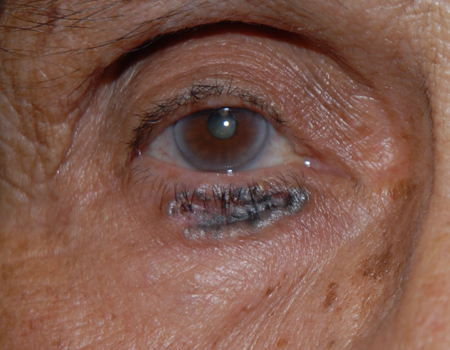 Basal Cell Carcinoma American Academy Of Ophthalmology