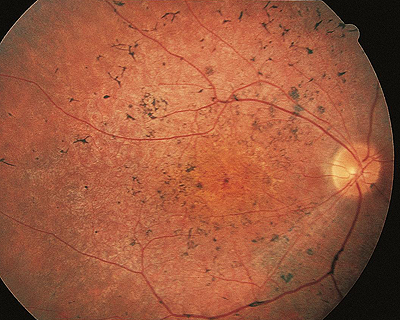 Pigmentosa retinitis Retinitis Pigmentosa
