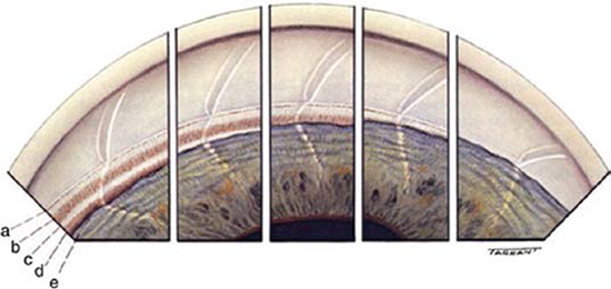Glaucoma Basics: Beyond the IOP