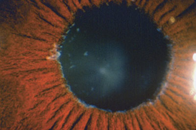 Pseudoexfoliative Material at the Pupillary Margin