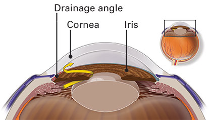 Illustration of a blocked drainage angle that causes glaucoma. The iris prevents fluid from draining through the drainage angle so pressure build up.