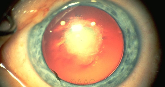 Dissolving-Cataracts