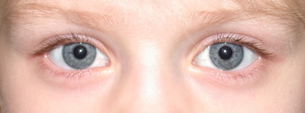 The Ongoing Challenge Of Intermittent Exotropia American Academy Of Ophthalmology