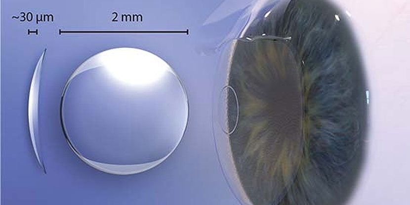 UPDATED TO FDA CLASS 1 DEVICE RECALL: Raindrop Near Vision Inlay may raise  risk of corneal haze - American Academy of Ophthalmology