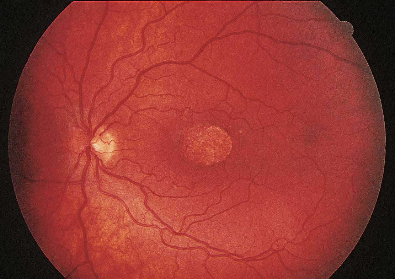 Изменение на глазном дне. Диабетическая ретинопатия глазное дно. Почечная гипертоническая ретинопатия. Гипертоническая ангиопатия и ретинопатия. Альбуминурическая ретинопатия.