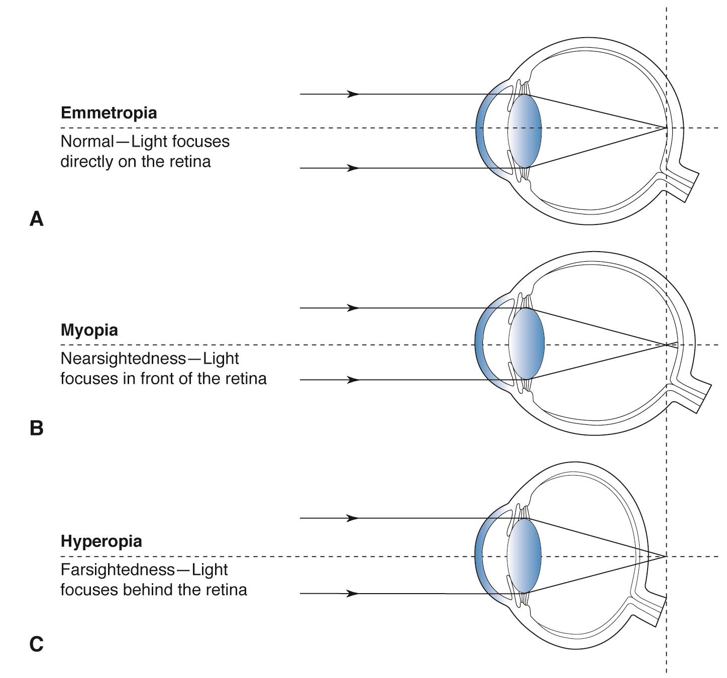 myopia hyperopia az