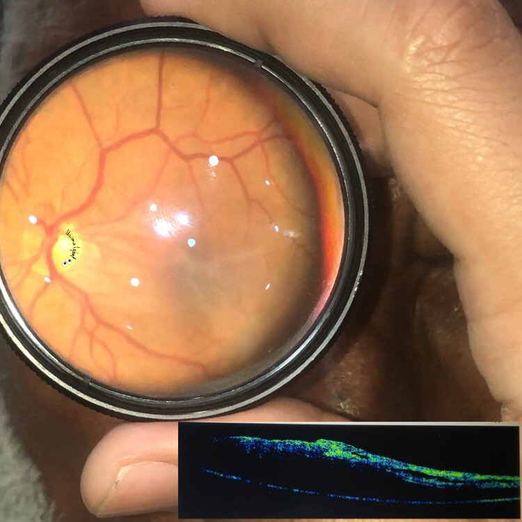 Macular Puckering American Academy Of Ophthalmology