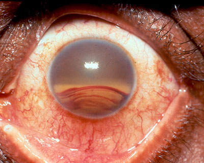Una fotografía de un hifema, cuando la sangre se acumula dentro del frente del ojo.