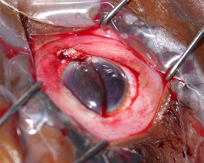 "Damage Control, Essential Actions in the Initial Management of Ocular Trauma"