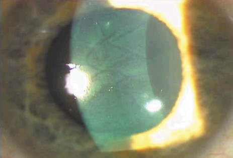 lasik laser striae keratomileusis situ staining negative flap surgery eye