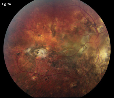 Fundus Findings 2A
