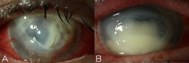 Figure 5. Fortified antibiotics should be employed for severe
cases of infectious keratitis, such as infiltrates resulting in stromal
necrosis (A) and hypopyon (B) along the visual axis.