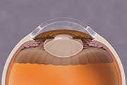 Donor cornea placement during transplant