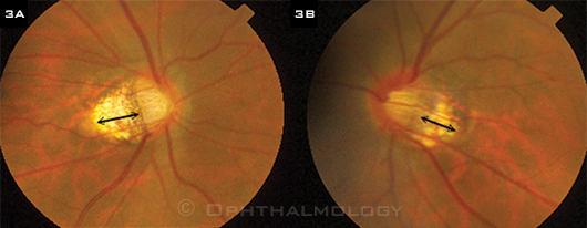 TILTED DISCS. (3A) Right and (3B) left optic nerves of highly myopic Chinese man with bilateral tilted discs and peripapillary atrophy (double arrows).
