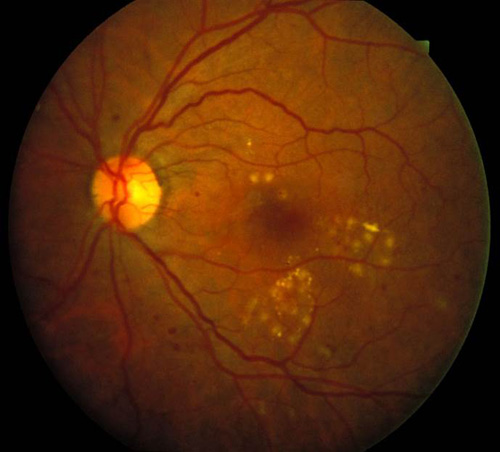What is the standard treatment for retinal scarring?