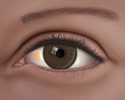 An illustration of an eye with a pinguecula
