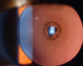 Cataract viewed with retroillumination