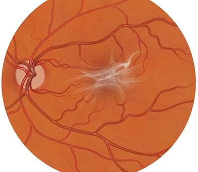 Ilustración del pliegue macular dentro del ojo.