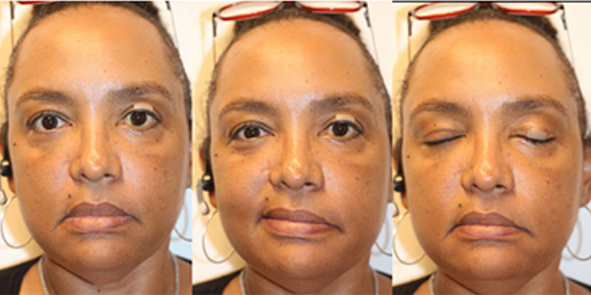 Managing Facial Nerve Palsy