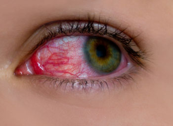 Close up of eye with red veins