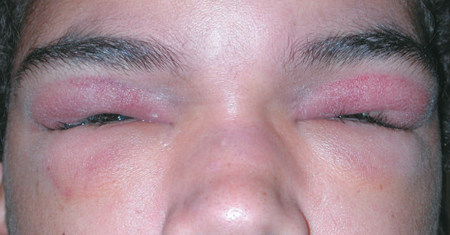 Eyelid Degenerative And Inflammatory Disorders American Academy