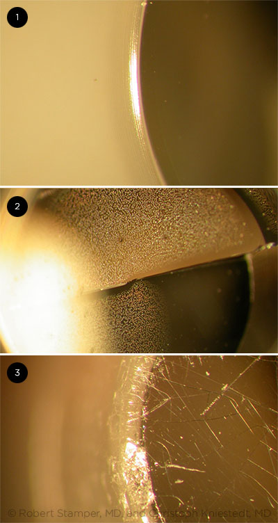 Slit Lamp Micrographs