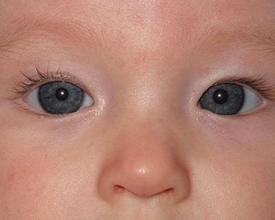 A close-up photograph of a child with pseudostrabismus. Although the eyes appear misaligned, the light reflection is in the same place in both eyes.