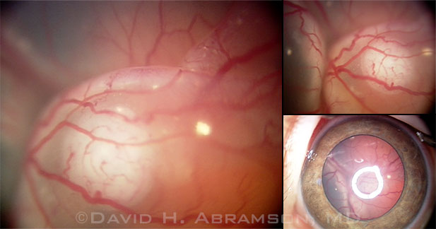 External and fundus photos of eye with unilateral RB, classified as group E (advanced), prior to treatment.