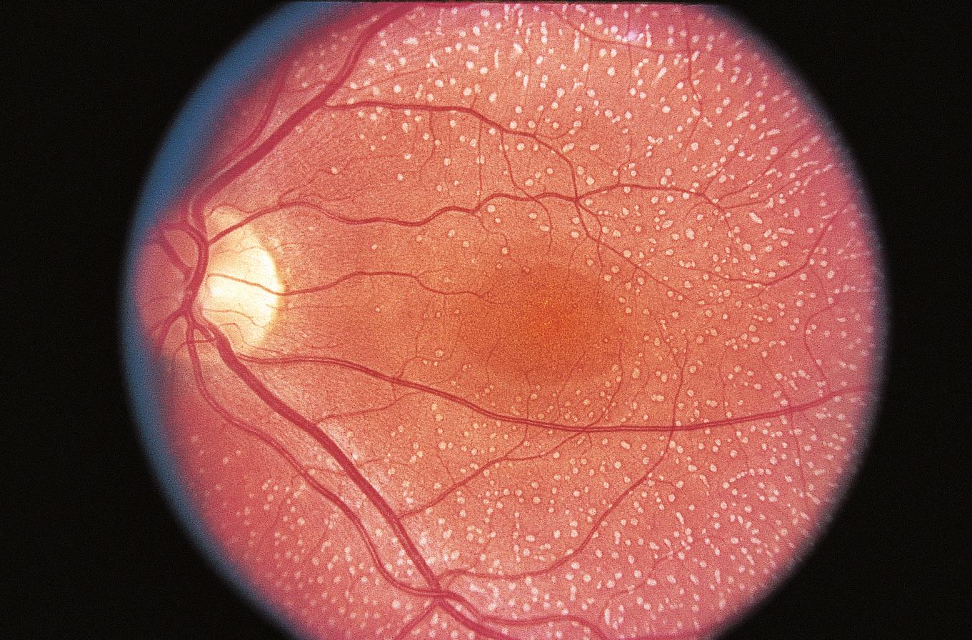 День сетчатки. Белоточечная дистрофия сетчатки. Пигментный ретинит сетчатки. Офтальмоскопия атрофия сетчатки.