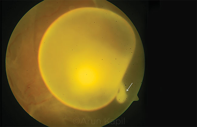 Intravitreal Cysticercosis With Exvaginated Scolex